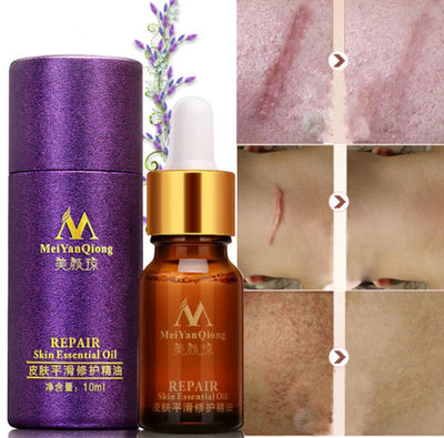 Renewing Skin Therapy Oil Lavender Infused Natural Care Blemish Relief Pure Formula Scar Reduction Stretch Mark Solution 10 ML