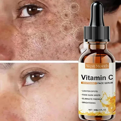 Vitamin C Whitening Serum Remove Freckles Dark Spots Face Essence Fade Melasma Melanin Brighten Repair Dull Skin Care Cosmetics